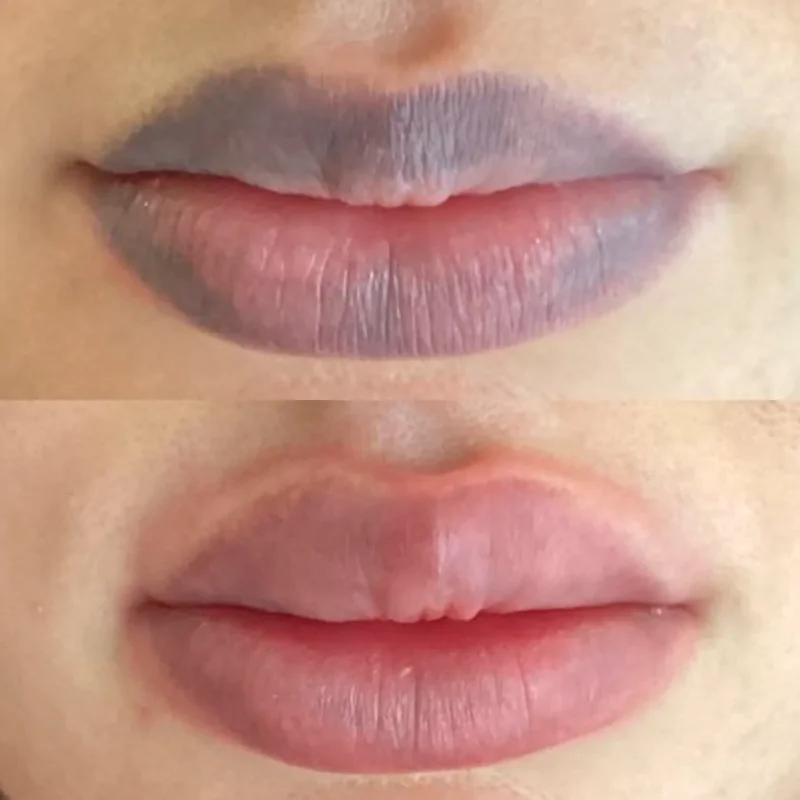 Maquillage permanent depigmentation